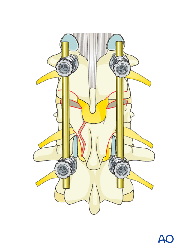 Thoracic and lumbar fractures: Posterior short segment fixation with pedicle screws