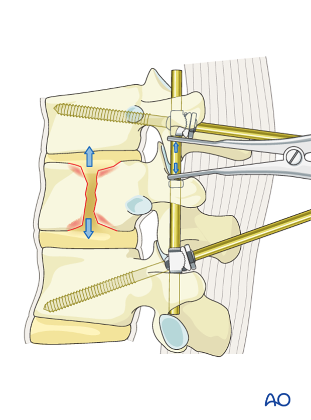 Thoracic and lumbar fractures: Posterior short segment fixation with Schanz pins