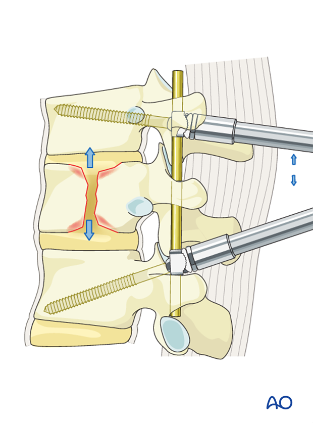 Thoracic and lumbar fractures: Posterior short segment fixation with Schanz pins