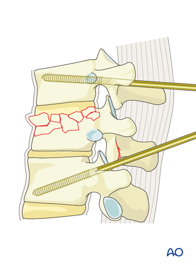 Posterior short segment fixation with Schanz pins for A3 Incomplete ...