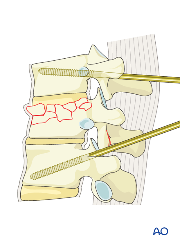 Thoracic and lumbar fractures: Posterior short segment fixation with Schanz pins