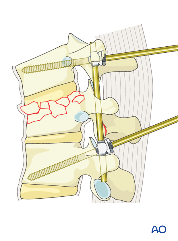 Thoracic and lumbar fractures: Posterior short segment fixation with Schanz pins