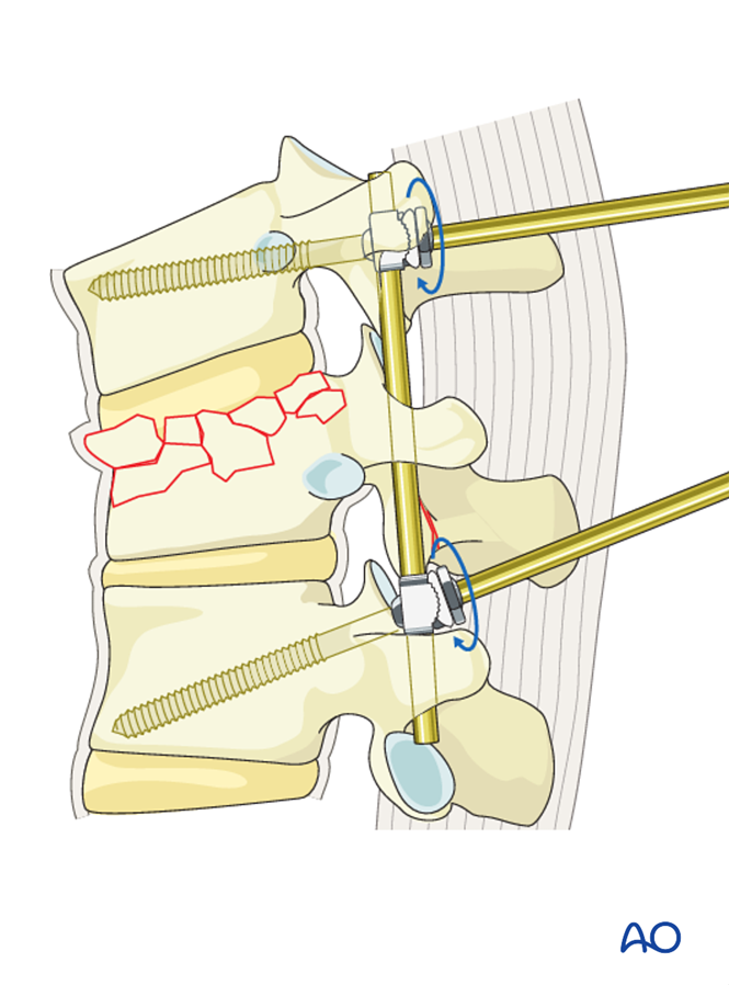 Posterior short segment fixation with Schanz pins for A3 Incomplete ...