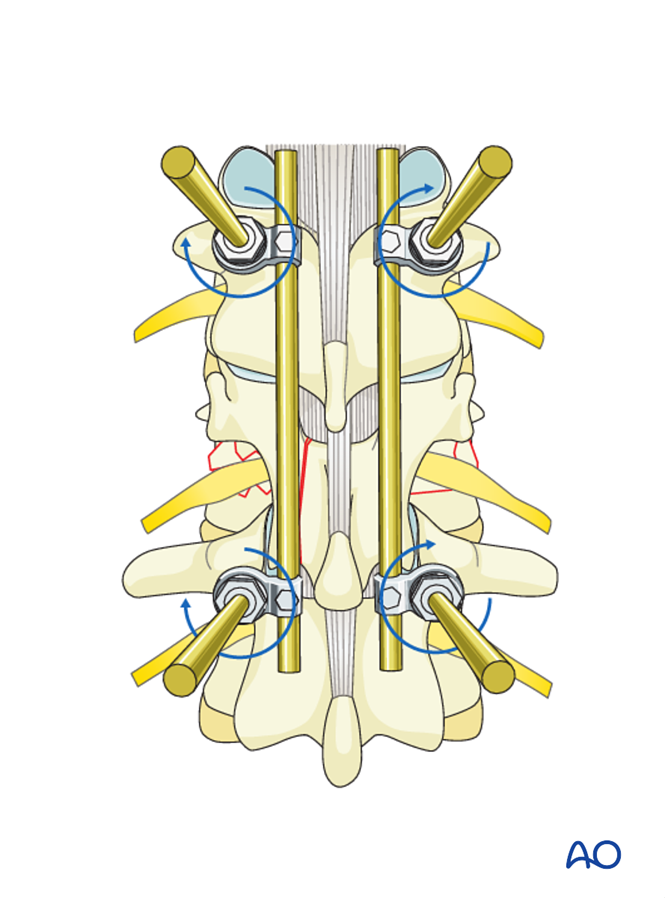 Posterior short segment fixation with Schanz pins for A3 Incomplete ...