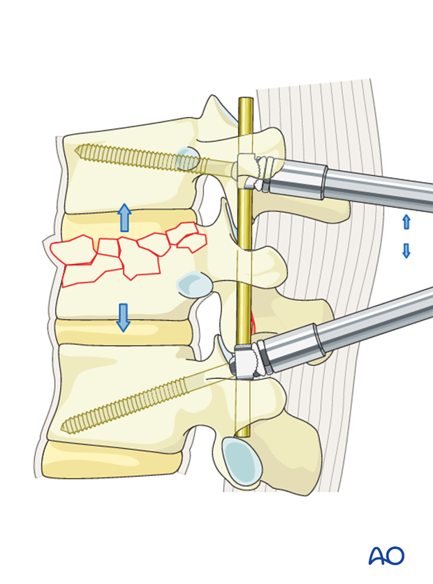 Thoracic and lumbar fractures: Posterior short segment fixation with Schanz pins