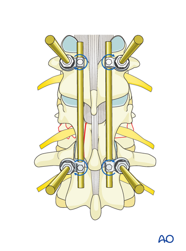 Thoracic and lumbar fractures: Posterior short segment fixation with Schanz pins