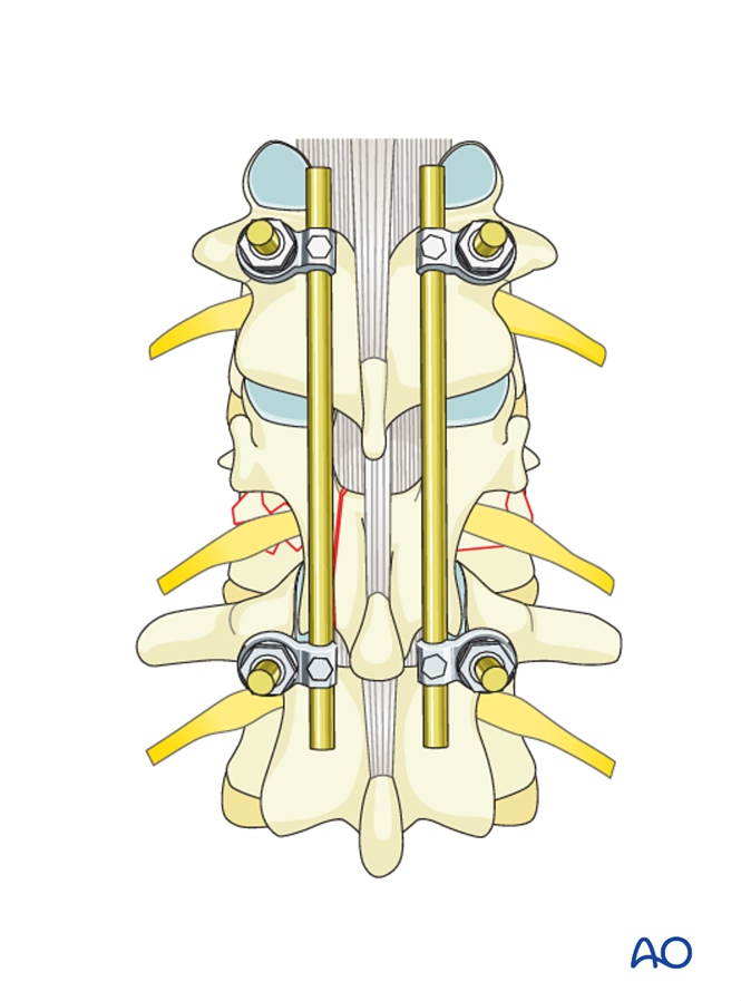 MIS posterior short segment fixation with Schanz pins for A3 Incomplete ...