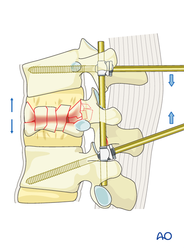 Thoracic and lumbar fractures: Posterior short segment fixation with Schanz pins