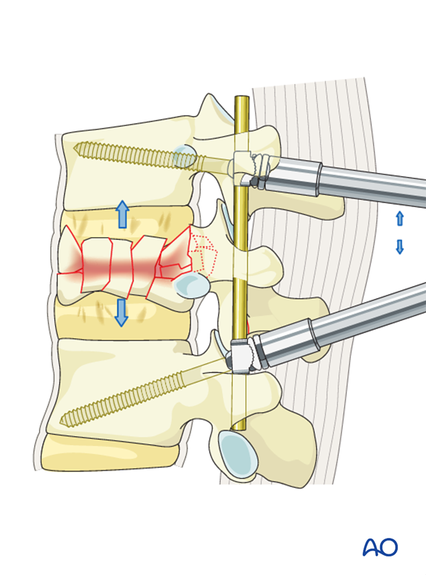 Thoracic and lumbar fractures: Posterior short segment fixation with Schanz pins