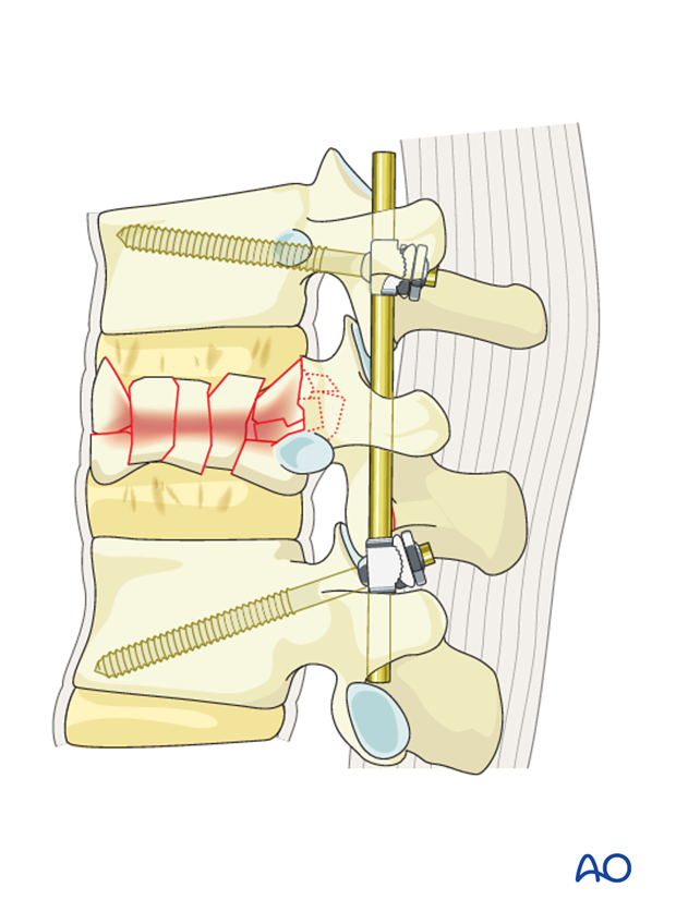 Thoracic and lumbar fractures: Posterior short segment fixation with Schanz pins