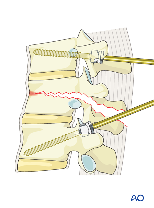 Thoracic and lumbar fractures: Posterior short segment fixation with Schanz pins