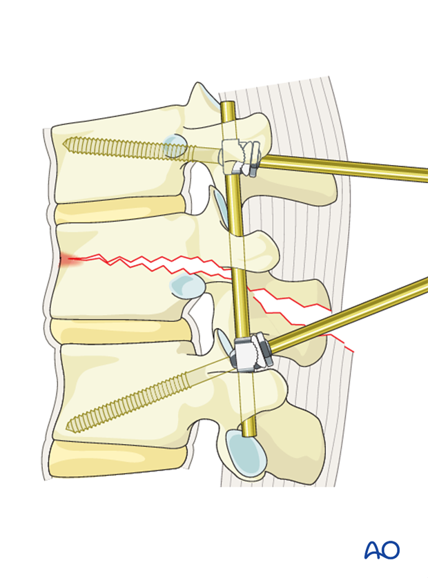 Thoracic and lumbar fractures: Posterior short segment fixation with Schanz pins