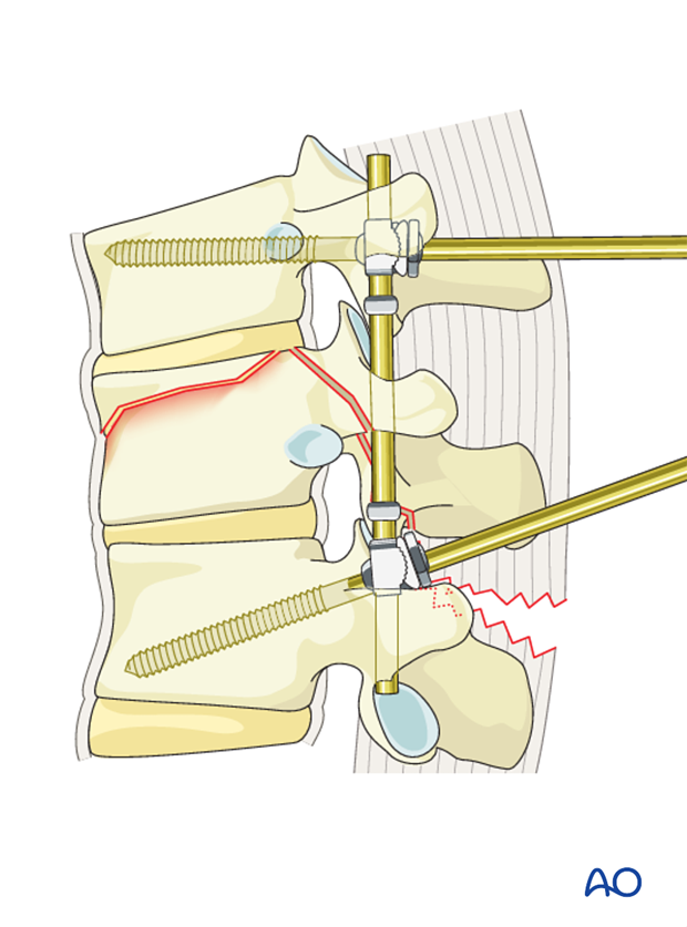 Thoracic and lumbar fractures: Posterior short segment fixation with Schanz pins