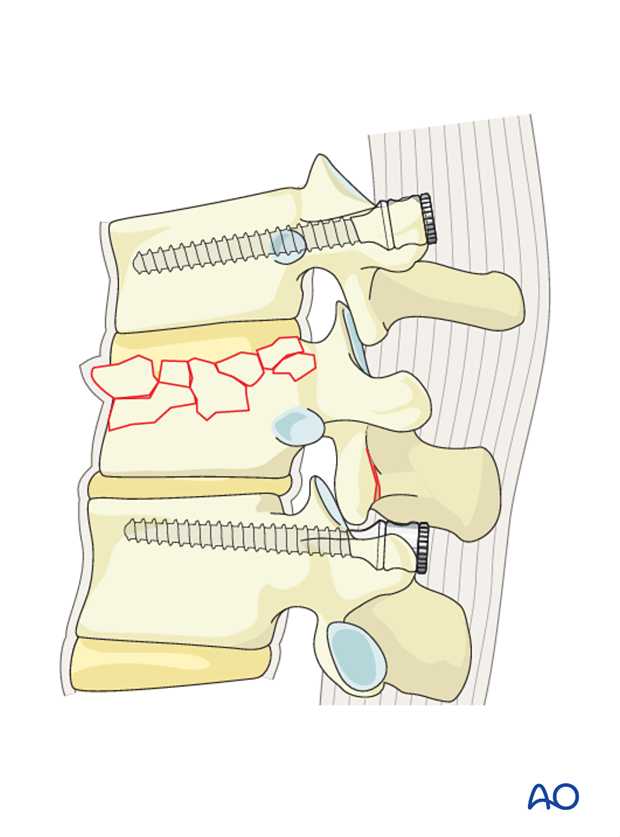 Thoracic and lumbar fractures: Posterior short segment fixation with intermediate screws (PSSF-IS)