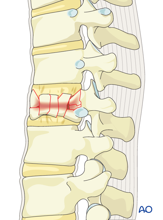 Thoracic and lumbar fractures: Posterior long segment fixation