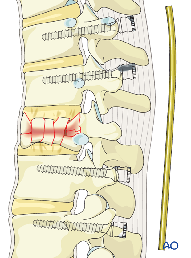 Thoracic and lumbar fractures: Posterior long segment fixation