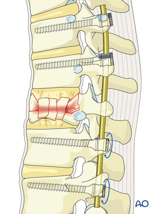 Thoracic and lumbar fractures: Posterior long segment fixation
