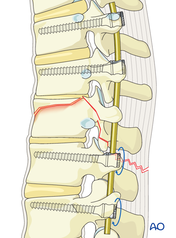 Thoracic and lumbar fractures: Posterior long segment fixation