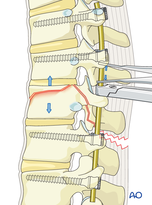 Thoracic and lumbar fractures: Posterior long segment fixation