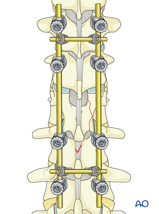 Thoracic and lumbar fractures: Posterior long segment fixation