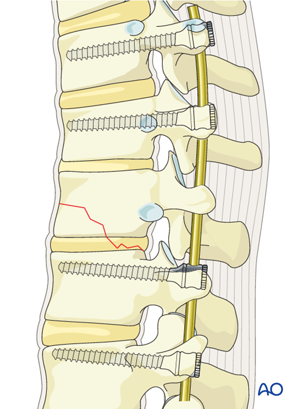 Thoracic and lumbar fractures: Posterior long segment fixation