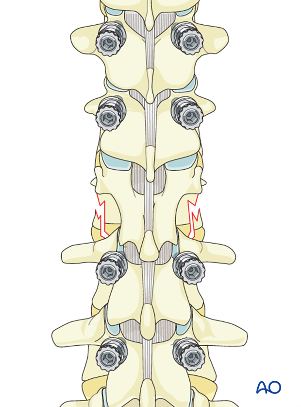 Thoracic and lumbar fractures: Posterior long segment fixation