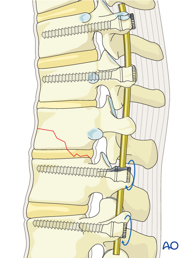 Thoracic and lumbar fractures: Posterior long segment fixation