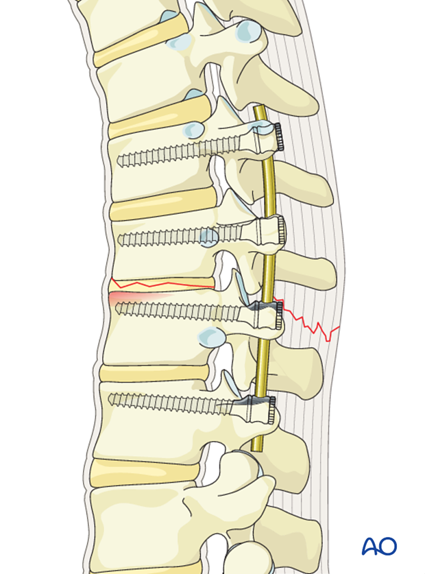 Thoracic and lumbar fractures: Posterior long segment fixation (type C fractures)