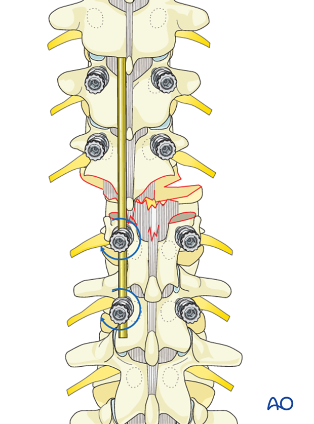 Thoracic and lumbar fractures: Posterior long segment fixation (type C fractures)