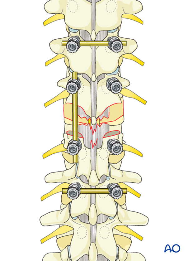 Thoracic and lumbar fractures: Posterior long segment fixation (type C fractures)