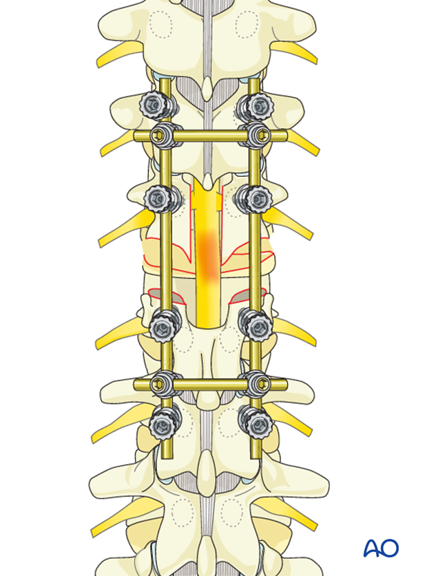 Thoracic and lumbar fractures: Posterior long segment fixation (type C fractures)