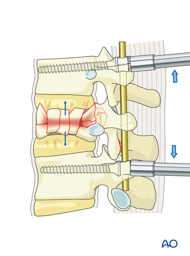 Thoracic and Lumbar fractures: MIS posterior short segment fixation with pedicle screws