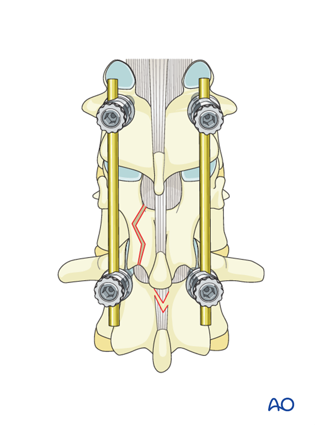 Thoracic and Lumbar fractures: MIS posterior short segment fixation with pedicle screws