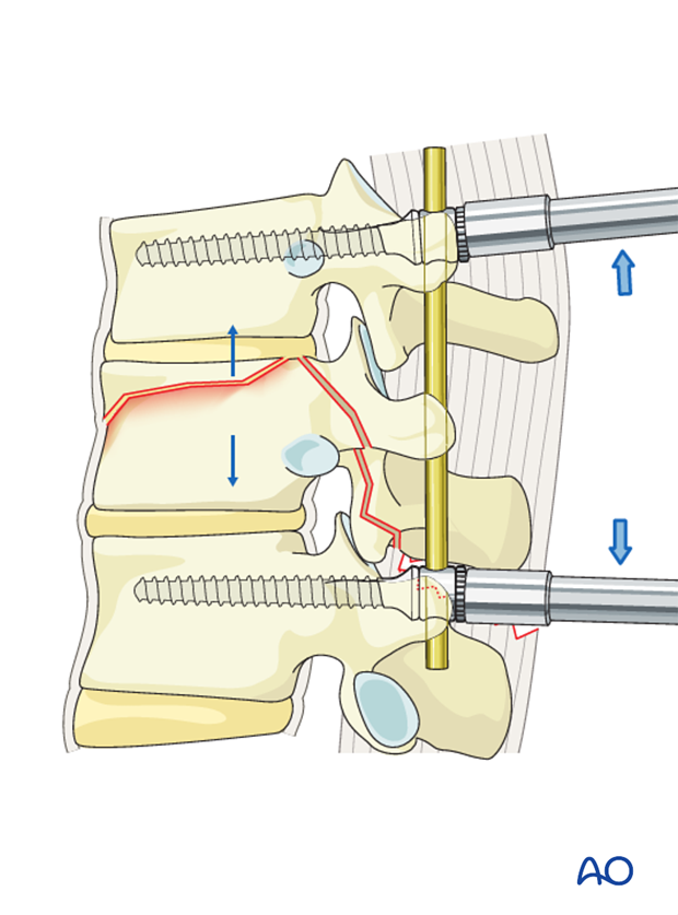Thoracic and Lumbar fractures: MIS posterior short segment fixation with pedicle screws