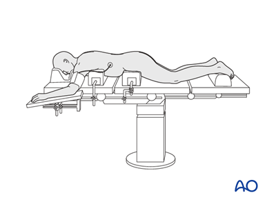 Prone position for posterior open approach - midline approach (T1-S1)