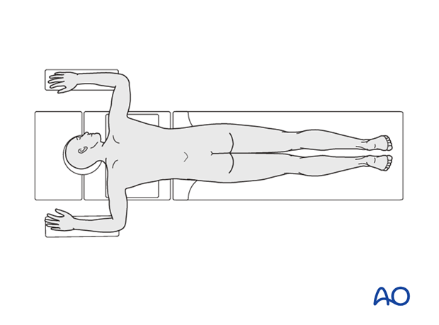 Patient positioned on a radiolucent table in prone position with arms abducted for surgery that starts below T8