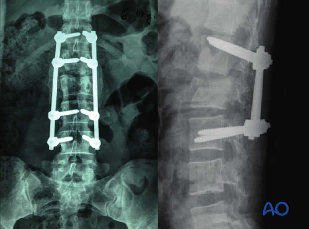 Thoracic and lumbar fractures: Aftercare for posterior procedures