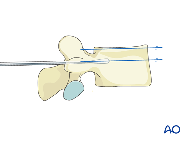 Cranial-caudal angulation during pedicle screw insertion in the thoracolumbar spine.