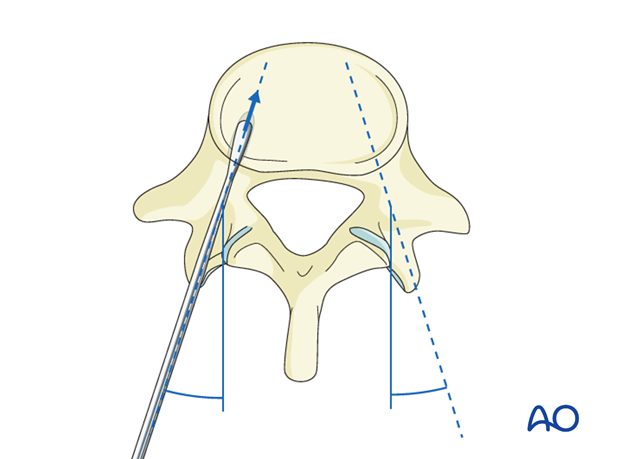 Medio-lateral inclination during pedicle screw insertion in the thoracolumbar spine.