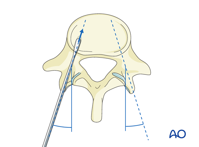 Pedicle screw insertion in the lumbar spine