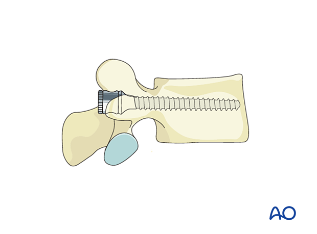 A pedicle screw of appropriate diameter and length is carefully inserted into the thoracolumbar spine.