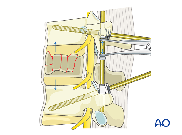 Indirect decompression/ligamentotaxis with schanz screws