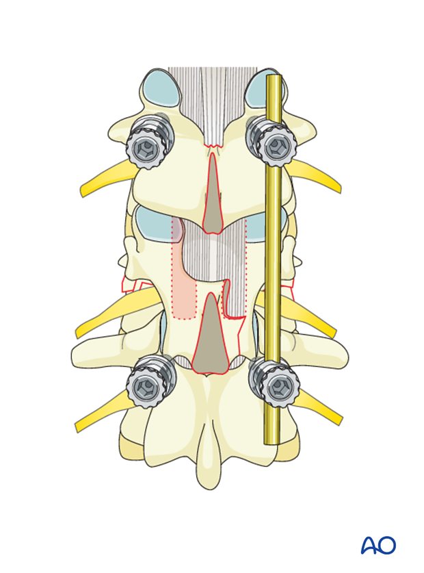 posterior decompression techniques