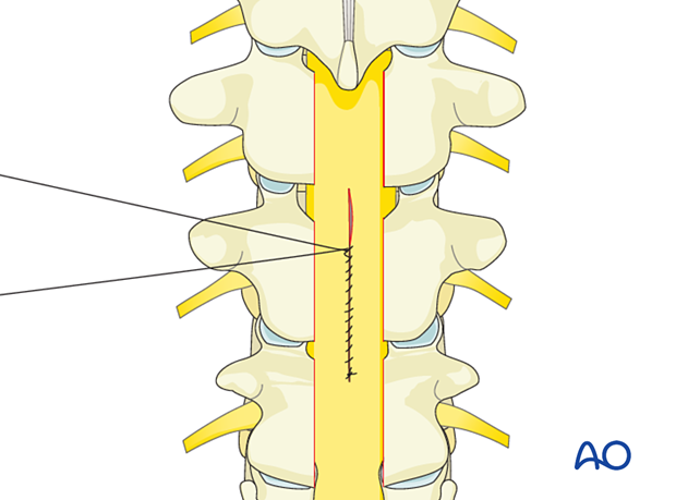 Repair of dural laceration in the spine