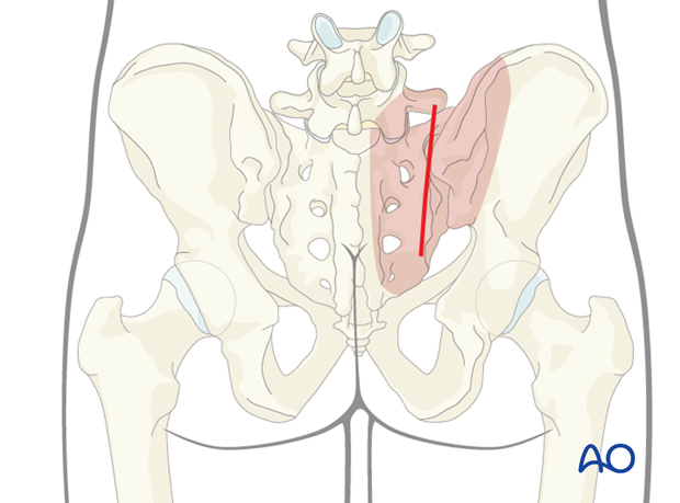 posterior paramedian approach to the sacrum