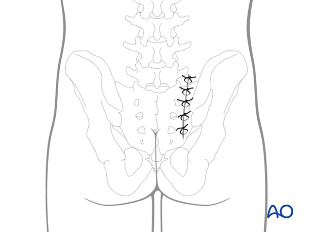 posterior paramedian approach to the sacrum