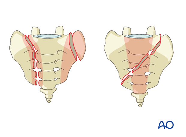 posterior midline approach to the sacrum