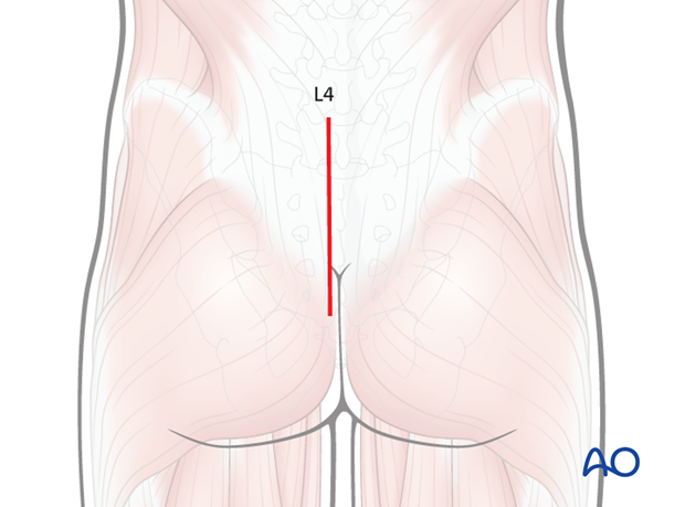 posterior midline approach to the sacrum