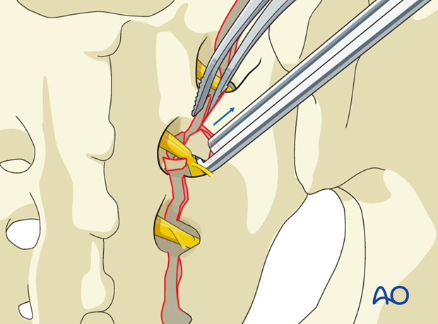 spinopelvic fixation