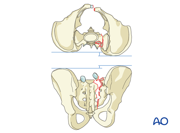 spinopelvic fixation